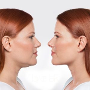 Injektionsbehandling Belkyra