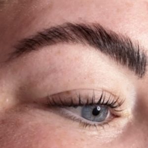 Brow Lift